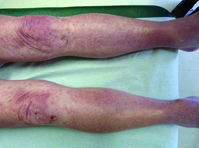 eruption eczematiforme diffuse