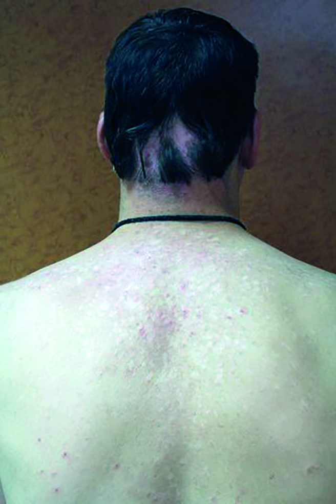 syndrome de Buckley, vitiligo, pelade