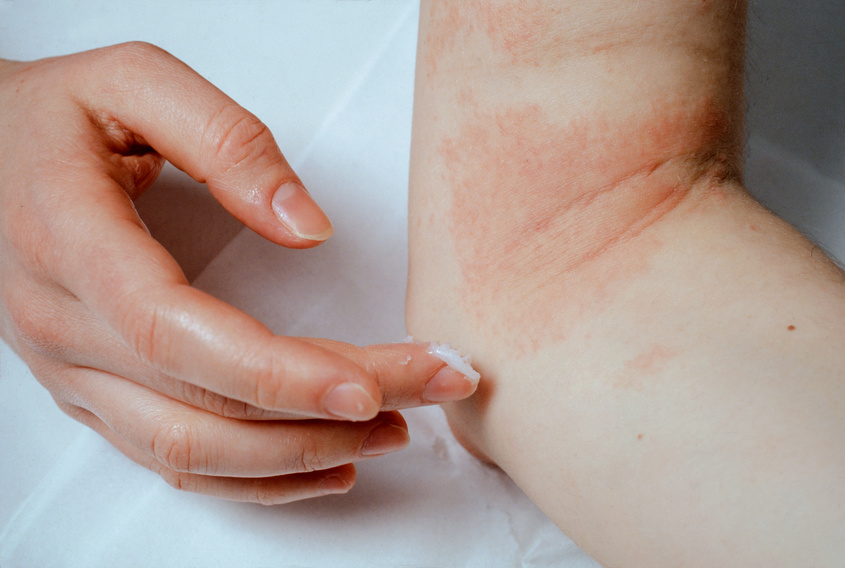 traitements eczema