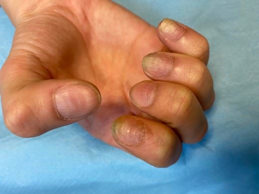 Ongles peladiques Photos (b) trachyonychie des ongles des doigts avec onycholyse, et lignes de Beau