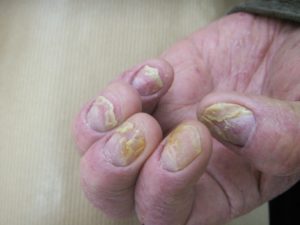 psoriasis-ongle