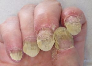 psoriasis-ongle