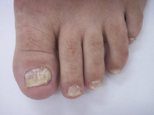 psoriasis-ongle