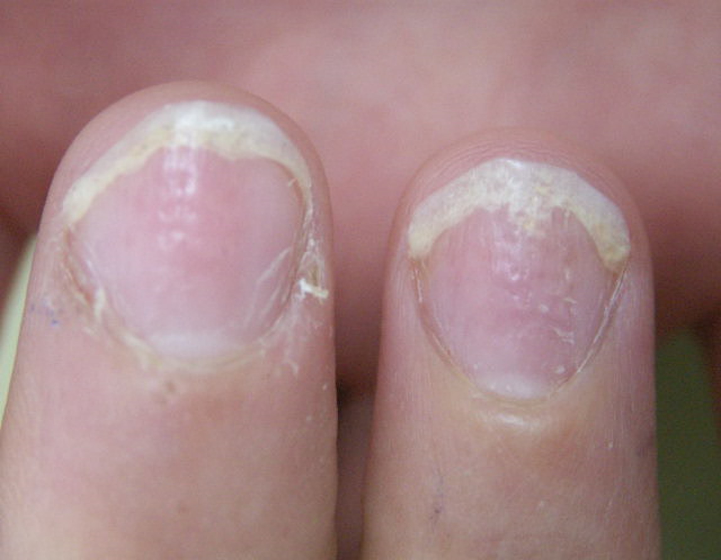 psoriasis-ongle