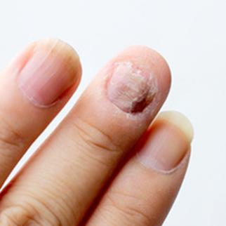 psoriasis des ongles