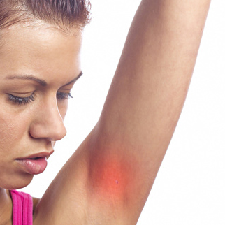psoriasis