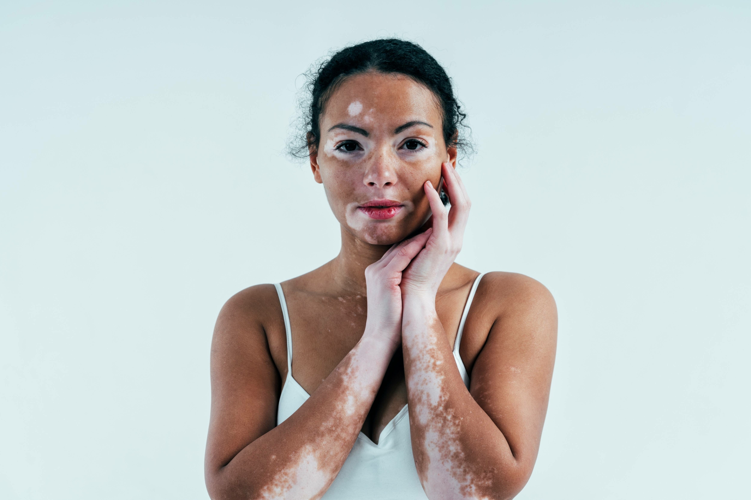 vitiligo