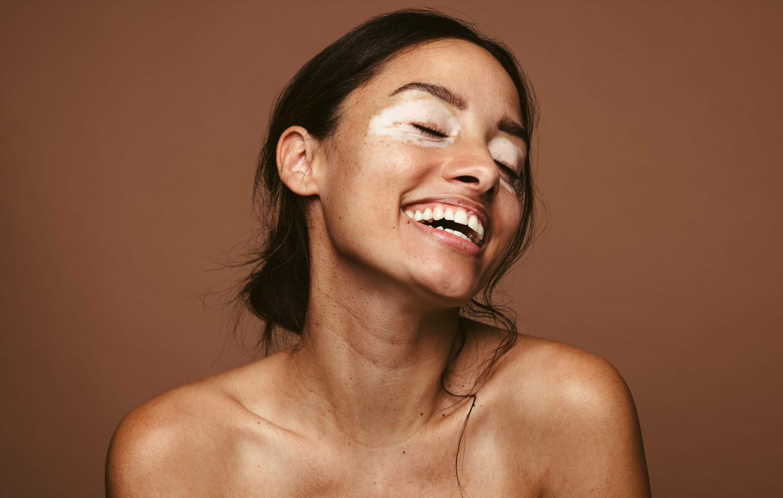 vitiligo-femme