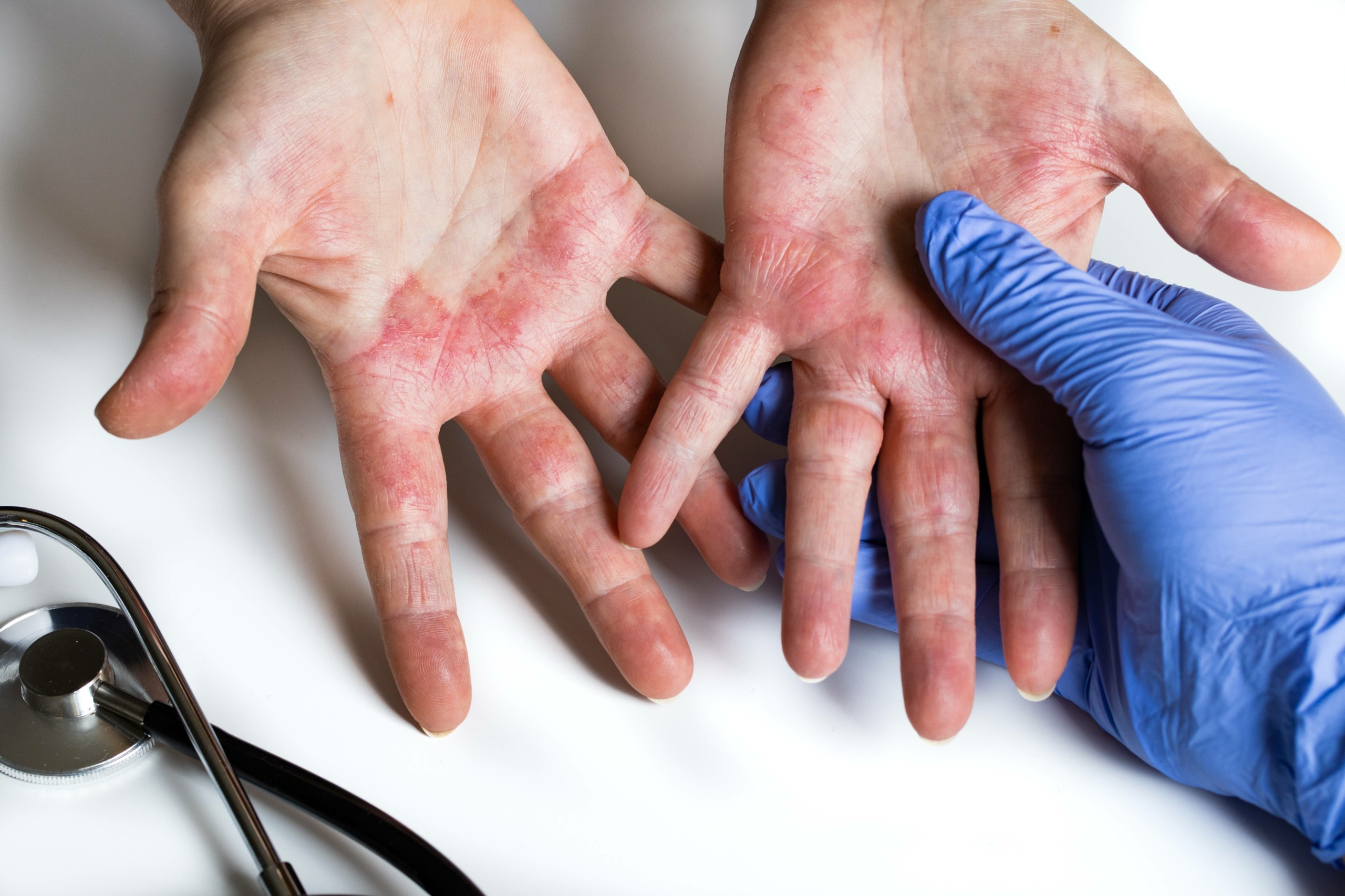 eczema des mains