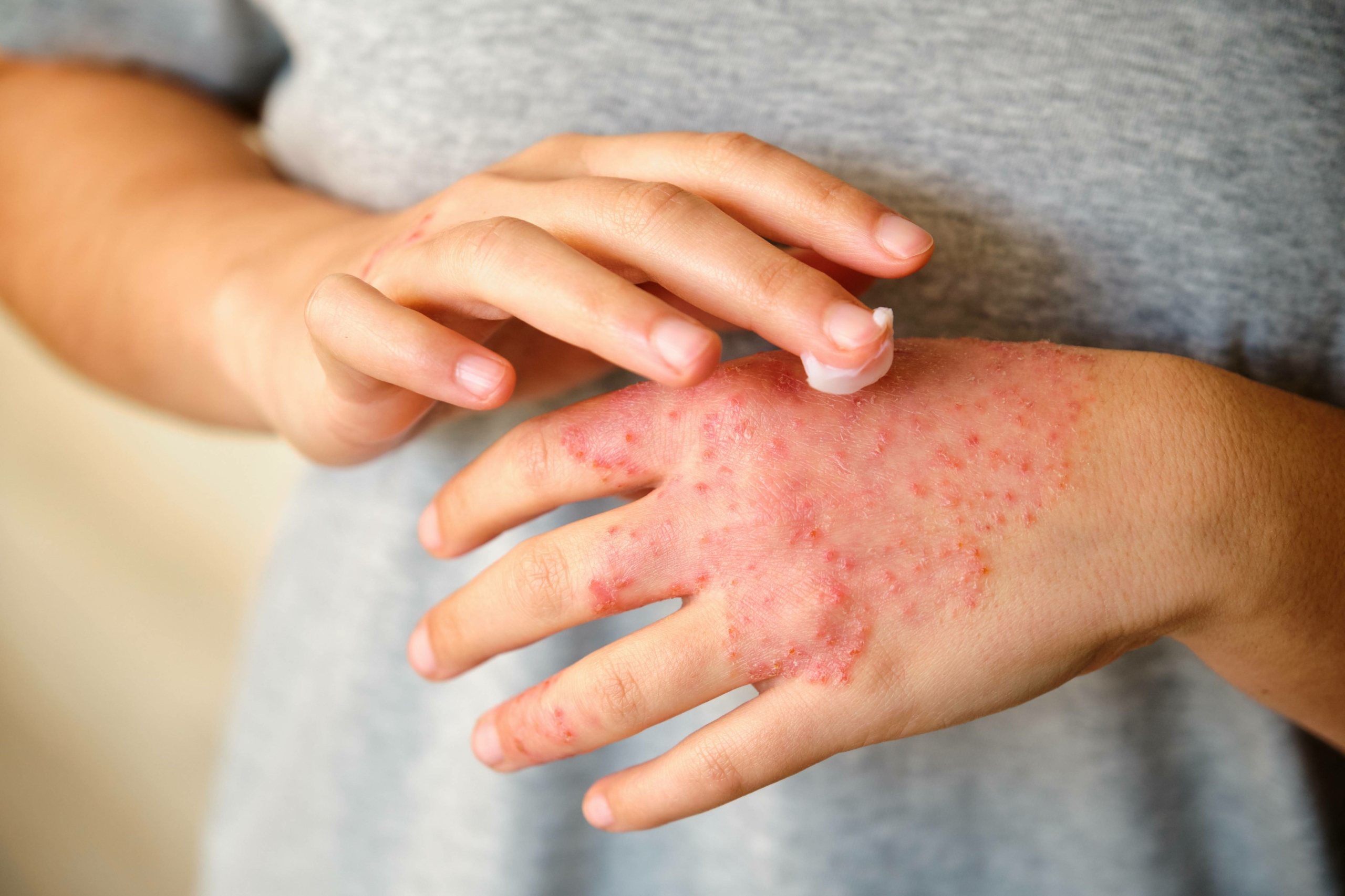 traitement eczema des mains