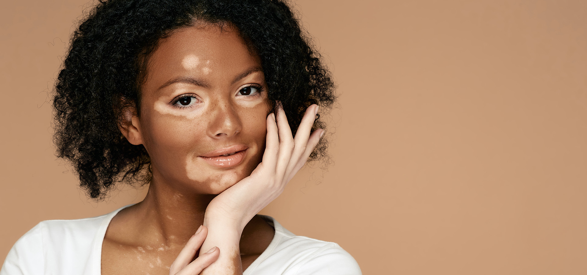 banniere-web-RESO-COLLECTIF-VITILIGO