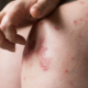 psoriasis-en-gouttes