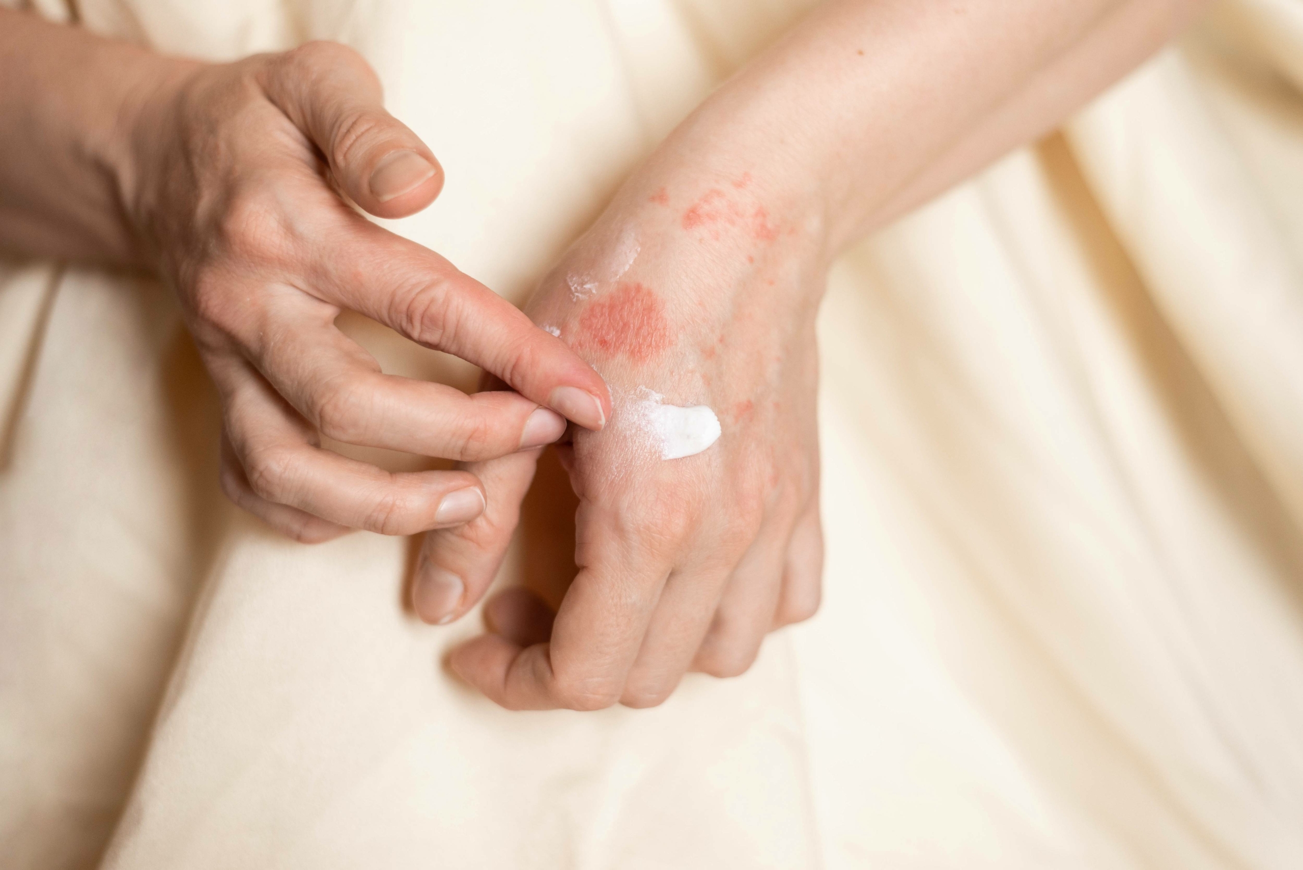 eczema-traitement-mains