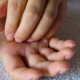 reso dermatologie eczema des mains