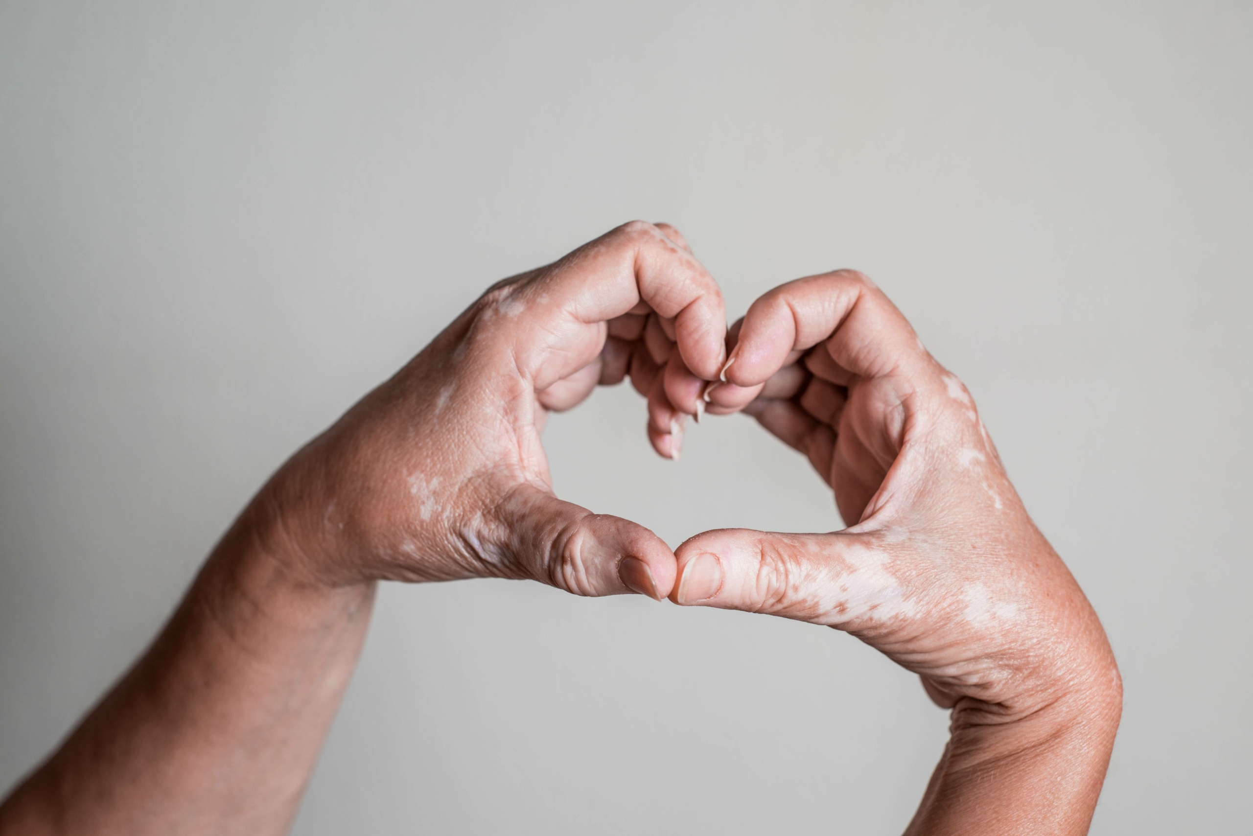 soutien vitiligo
