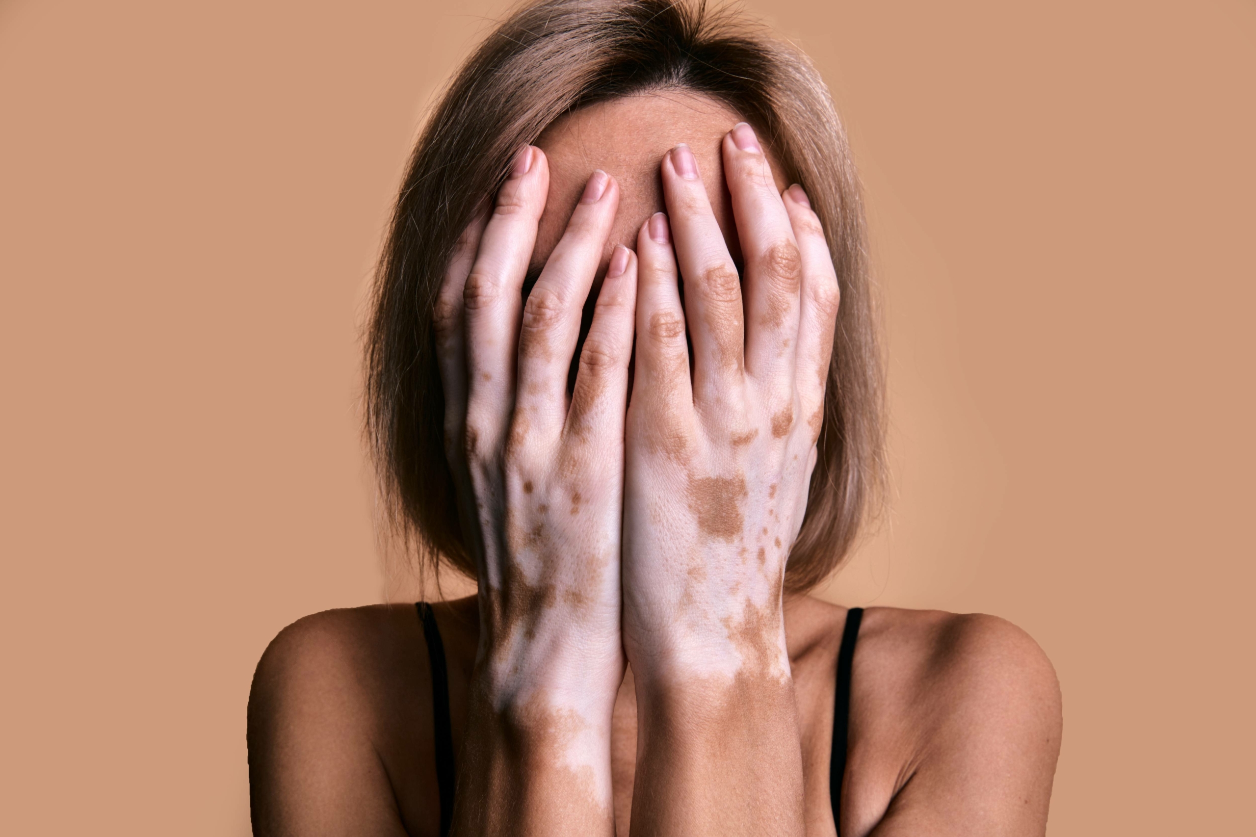 vitiligo souffrance psychologique