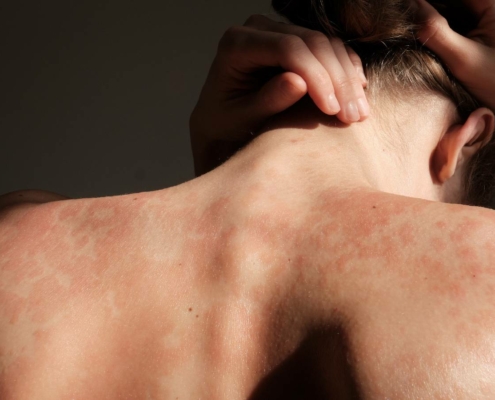 journee mondiale du psoriasis-100 (1)