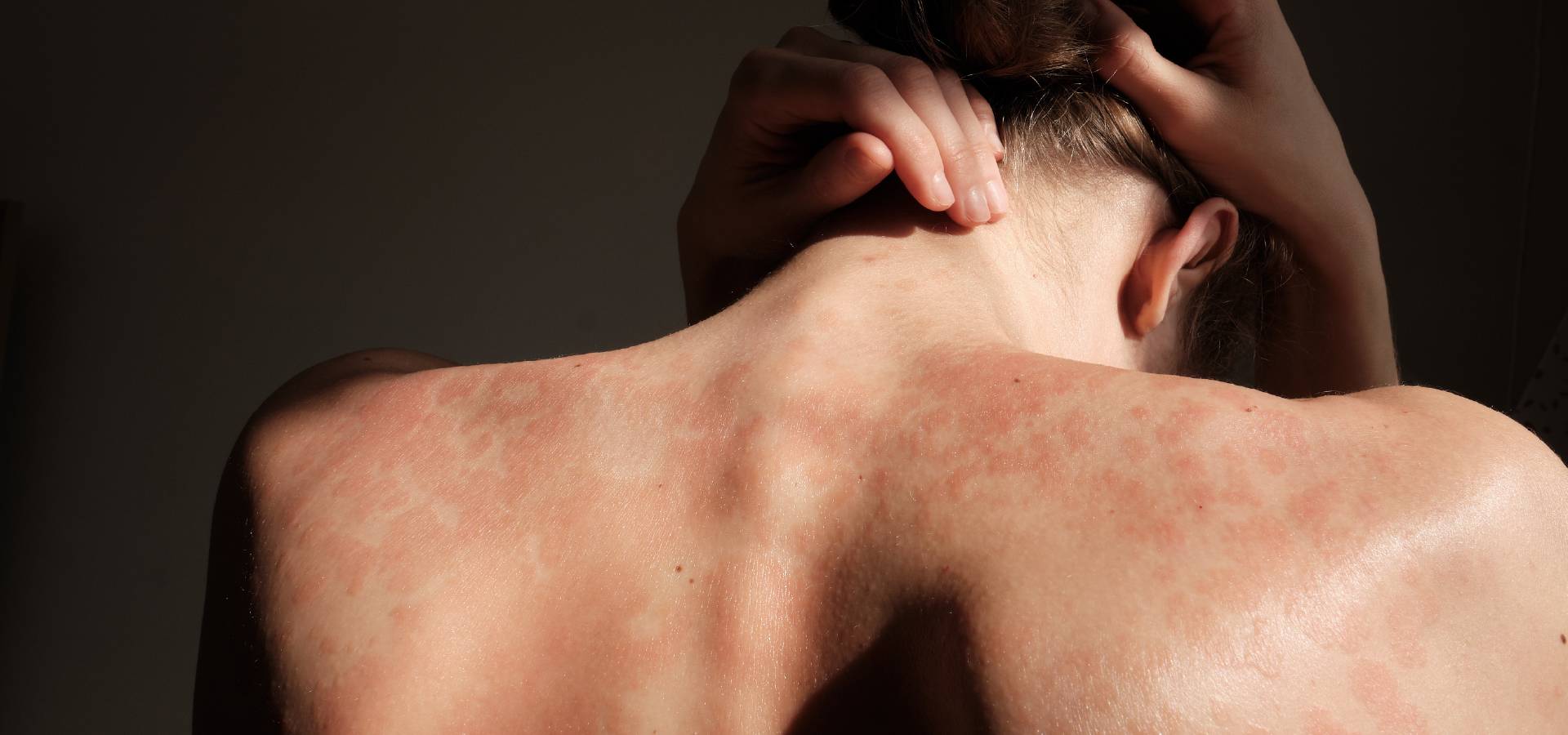 journee mondiale du psoriasis-100 (1)