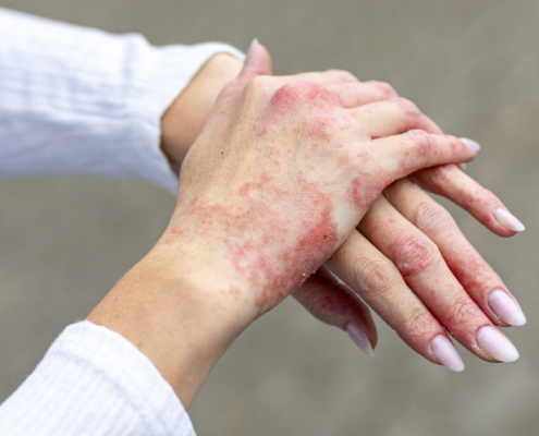 eczema des mains