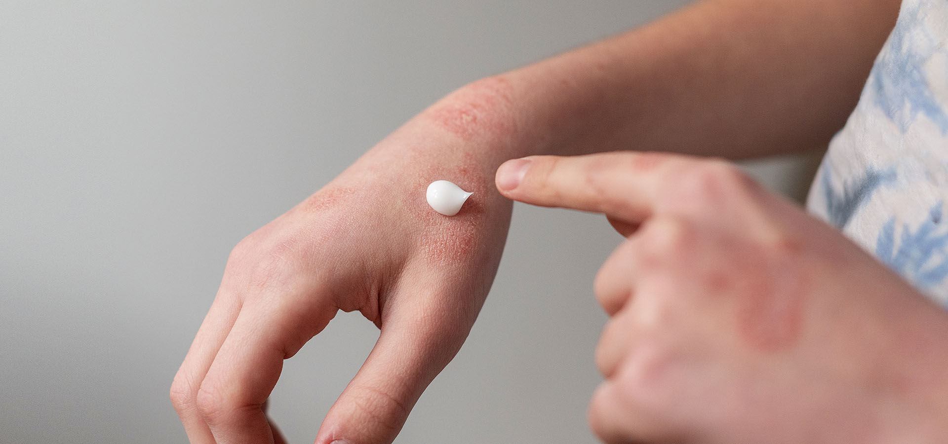 traitement creme eczema