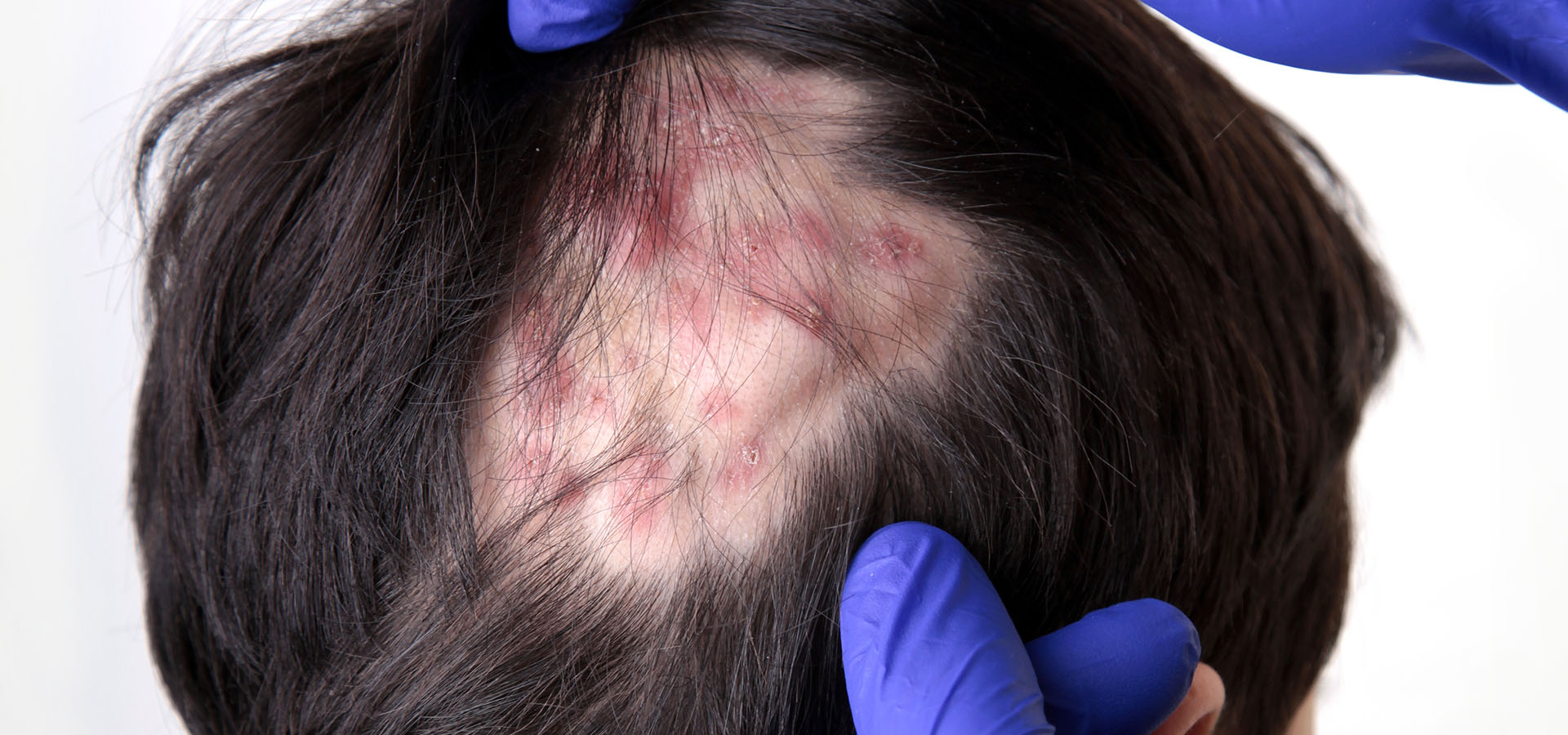 pelade et eczema pelade et eczema