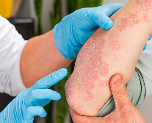 reduction dose biotherapies psoriasis