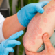 reduction dose biotherapies psoriasis