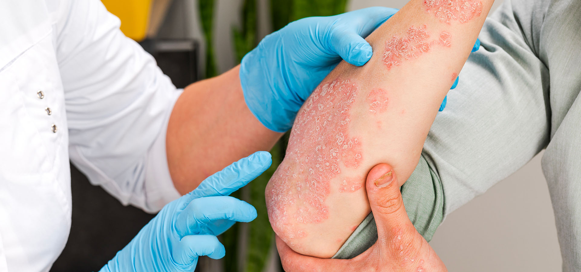 reduction dose biotherapies psoriasis