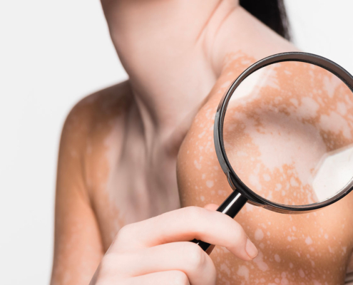 vitiligo
