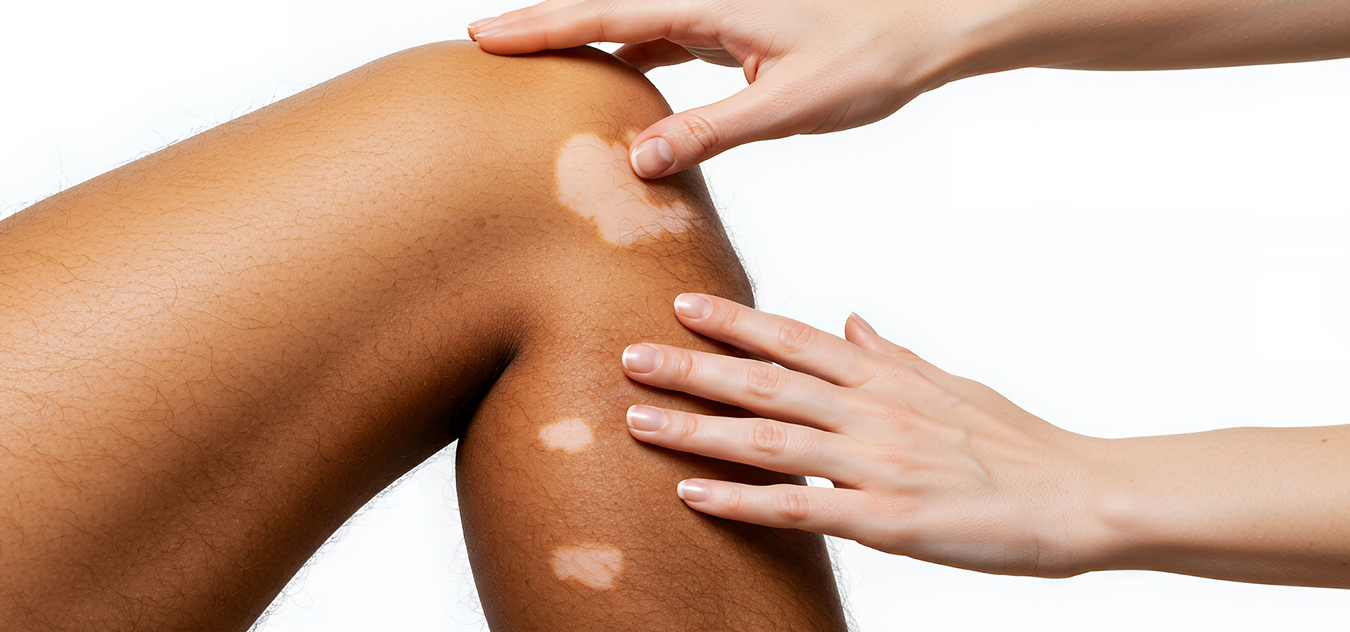 vitiligo-critere-severite