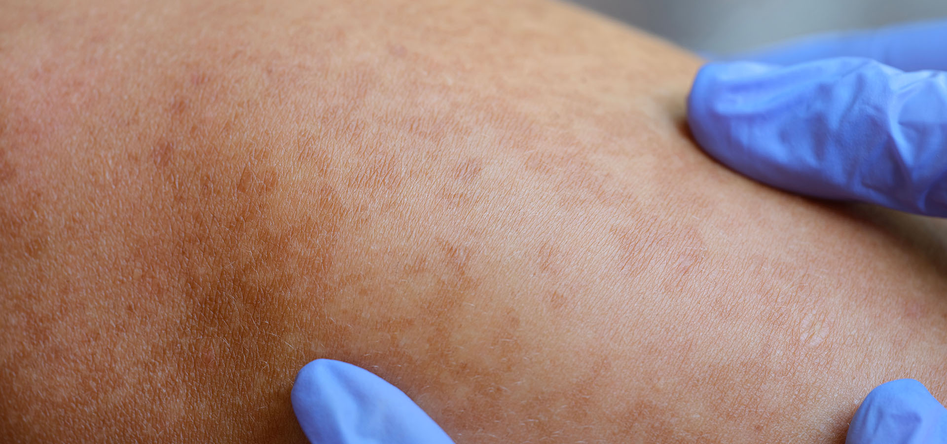 vitiligo-recherche-dermatologue