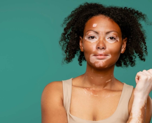 banniere-vitiligo