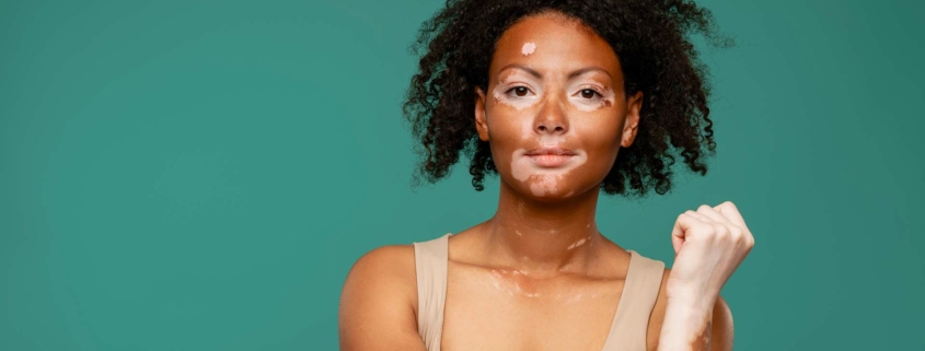 banniere-vitiligo