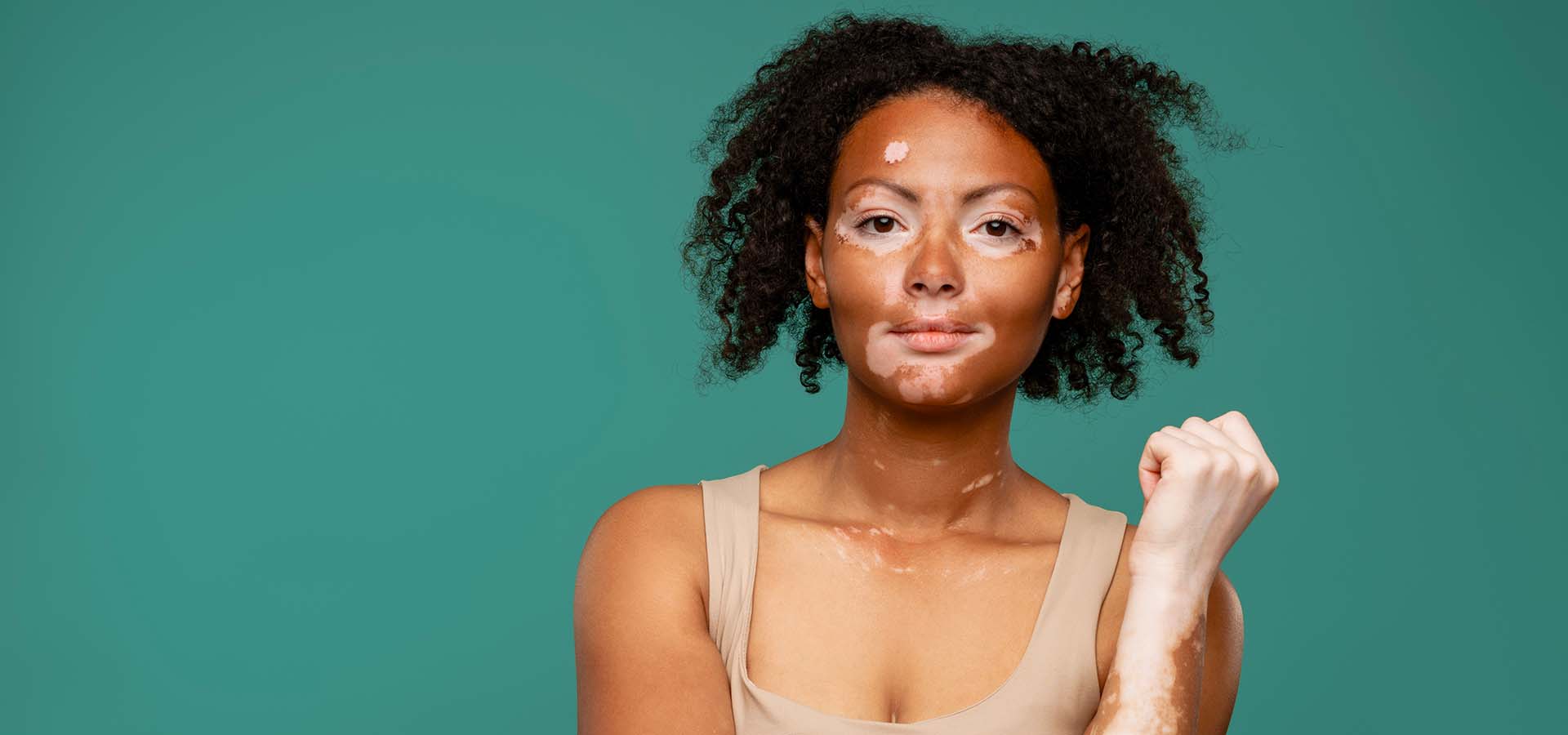 banniere-vitiligo