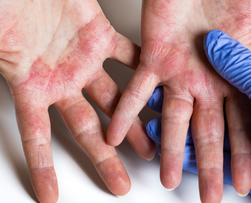 banniere-web-parcours-patient-eczema-mains