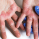 banniere-web-parcours-patient-eczema-mains
