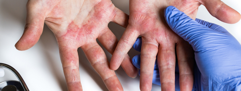 banniere-web-parcours-patient-eczema-mains