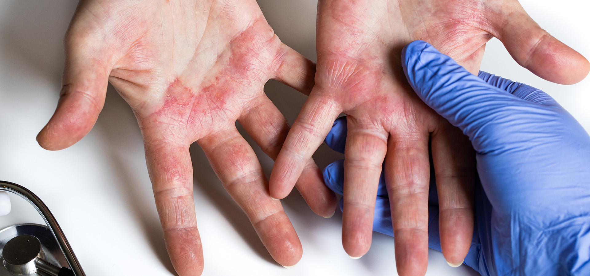 banniere-web-parcours-patient-eczema-mains banniere-web-parcours-patient-eczema-mains