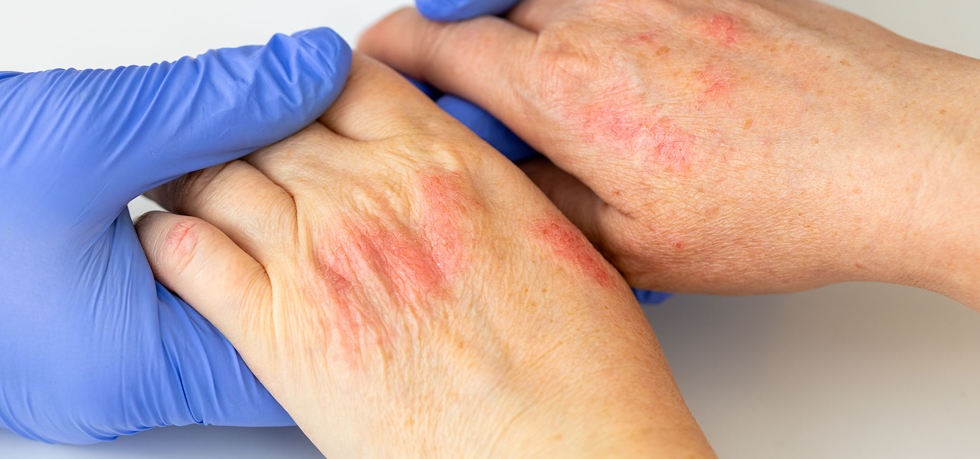 diagnostic-eczema-mains diagnostic-eczema-mains