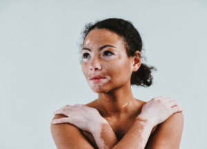 vitiligo vitiligo