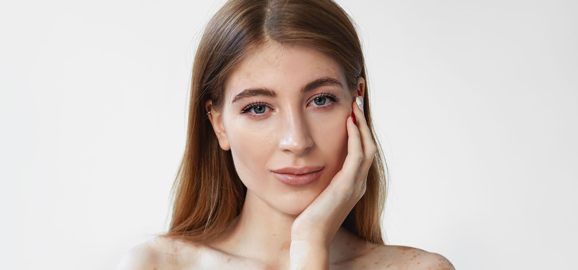 vitiligo traitement