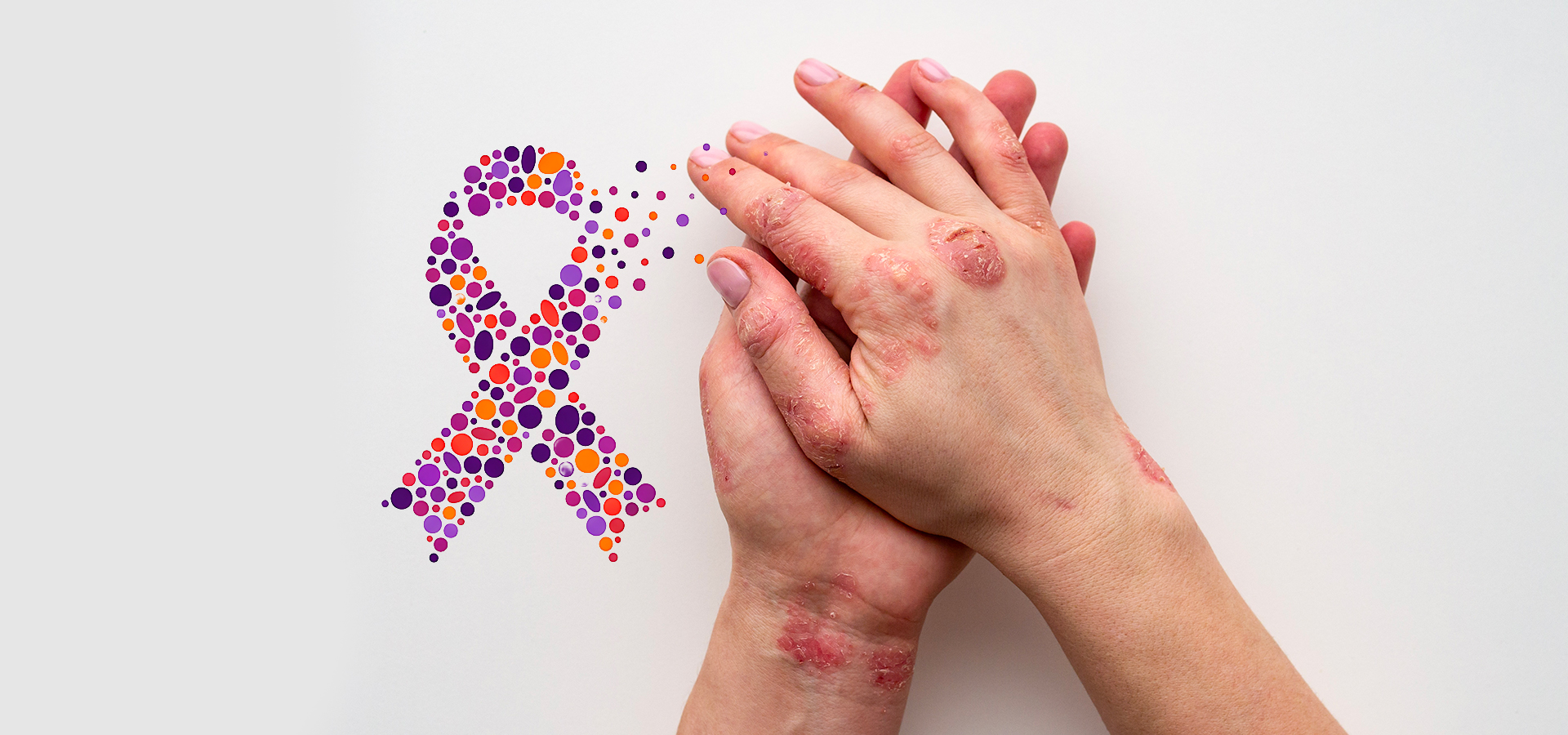 journee-mondiale-psoriasis journee-mondiale-psoriasis